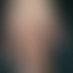 Fingerknöchelpolster, echte. Über Jahre langsam progredient wachsende, braun-rote, schmerzlose, i...