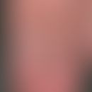 Fingervarikosis: chronische, stationäre, nicht mehr zunehmende Schwellung sowie geschlängelte und...