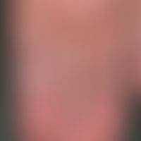 Finger varicosis: chronic, stationary, no longer increasing swelling as well as tortuous and nodu...