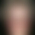 flush phenomena. sudden facial erythema with hot flush and tingling itching of the facial skin (h...