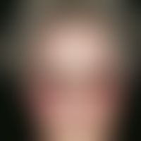 flush phenomena. sudden facial erythema with hot flush and tingling itching of the facial skin (h...