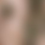 Folliculitis decalvans: extensive scarring inflammation with destruction of the hair follicles, t...