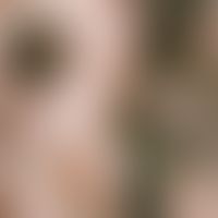 Folliculitis decalvans: extensive scarring inflammation with destruction of the hair follicles, t...
