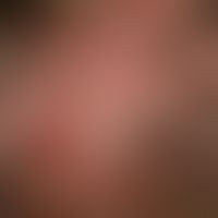 Folliculitis decalvans:&nbsp;seit 12 Monaten persistierender vernarbender Haarausfall, mit anfäng...