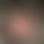 Folliculitis decalvans. 4 years of persistent, chronically active, progressive, red, follicle-rel...