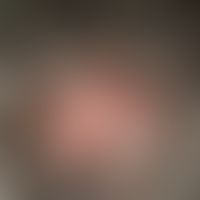 Folliculitis decalvans:&nbsp;seit 4 Jahren persistierende, chronisch aktive, progrediente, rote, ...