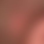 Folliculitis decalvans, circumscribed scarring alopecia with extensive reddening of the skin.
