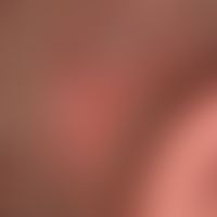 Folliculitis decalvans:&nbsp;umschriebene vernarbende Alopezie mit flächiger Rötung der Haut. Ste...