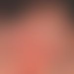 Folliculitis decalvans, massive extensive scarring, currently no inflammatory activity of the pro...