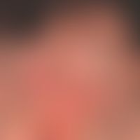 Folliculitis decalvans:&nbsp;massive flächenhafte Vernarbungen. Derzeit keine entzündliche Aktvit...