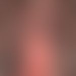 Folliculitis decalvans: Initial changes, scalp appears swollen, with sunken, conspicuously promin...