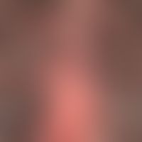 Follikulitis decalvans: initiale Veränderungen, Haarboden erscheint aufgequollen, mit eingesunken...