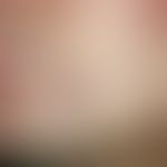 Folliculitis profunda. solitary, acute, since 4 weeks existing, 1.2 cm large, sharply definable, ...