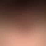 Acne keloidalis nuchae. 7-year-old patient with multiple erythematous papules and nodules in the ...