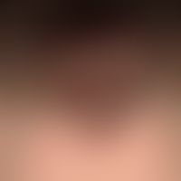 Acne keloidalis nuchae. 7-year-old patient with multiple erythematous papules and nodules in the ...