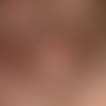 Acne keloidalis nuchaeDetail magnification: Multiple, solitary or confluent, bright red papules, ...