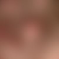 Acne keloidalis nuchaeDetail magnification: Multiple, solitary or confluent, bright red papules, ...
