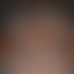 Acne keloidalis nuchae syn. folliculitissclerotisans nuchae: Survey picture: Since 6 years existi...