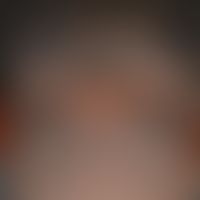 Acne keloidalis nuchae syn. folliculitissclerotisans nuchae: Survey picture: Since 6 years existi...