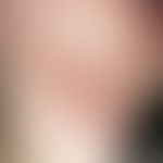Folliculitis barbae. multiple, chronically active (changing symptoms for the last 3 months), foll...