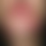 Folliculitis barbae. multiple, chronically active, increasing (since 3 months changeable symptoms...