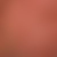 Folliculitis barbae: Massive purulent (ostio-)folliculitis after application of a tyrosine kinase...