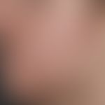 Folliculitis barbae: Chronic therapy-resistant, inflammatory follicular papules and pustules in t...