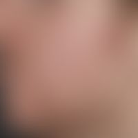 Folliculitis barbae: Chronic therapy-resistant, inflammatory follicular papules and pustules in t...