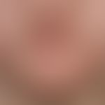 Folliculitis barbae: Chronic therapy-resistant, inflammatory follicular papules and pustules in t...