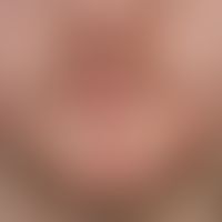 Folliculitis barbae: Chronic therapy-resistant, inflammatory follicular papules and pustules in t...