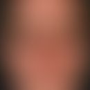 Follikulitis, gramnegative. Im Bereich der Gesichtshaut lokalisierte, disseminiert stehende, soli...
