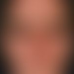 Follikulitis, gramnegative. Im Bereich der Gesichtshaut lokalisierte, disseminiert stehende, soli...
