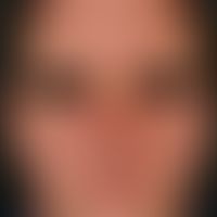 Follikulitis, gramnegative. Im Bereich der Gesichtshaut lokalisierte, disseminiert stehende, soli...