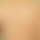 Folliculitis, perforating. irregular distribution of follicular, itchy papules with a central hor...
