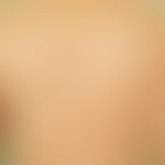 Folliculitis, perforating. irregular distribution of follicular, itchy papules with a central hor...