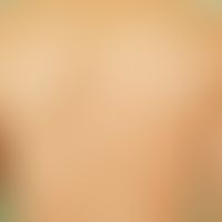 Folliculitis, perforating. irregular distribution of follicular, itchy papules with a central hor...