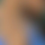 Fox-Fordyce's disease: skin-colouredpapules that are itchy, especially in cases of physical exert...
