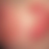 Frühlingsperniosis: rötlich-livide, sukkulente Auftreibung der Ohrmuschel mit Papeln und beginnen...