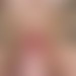 Furunkel. Solitärer, akut aufgetretener, seit 3 Tagen zunehmender, unscharf begrenzter, spontan s...