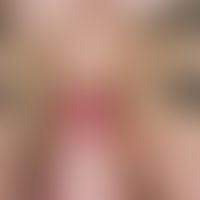 Furunkel. Solitärer, akut aufgetretener, seit 3 Tagen zunehmender, unscharf begrenzter, spontan s...