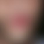 Lippenfurunkel. Akut aufgetretener, zunehmender, entzündlicher, fluktuierender, an der Oberlippe ...