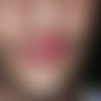 Lippenfurunkel. Akut aufgetretener, zunehmender, entzündlicher, fluktuierender, an der Oberlippe ...