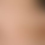 Furunculosis: multiple, different age, disseminated, dark brown to reddish, pressure-dolent papul...