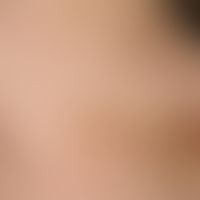 Furunculosis: multiple, different age, disseminated, dark brown to reddish, pressure-dolent papul...