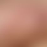 Detail enlargement: Multiple, disseminated, dark brown to reddish, pressure dolent papules on an ...