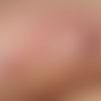 Detail enlargement: Multiple, disseminated, dark brown to reddish, pressure dolent papules on an ...