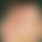 Fußinfekt, gramnegativer. Stark nässende, stellenweise krustig überlagerte, schmerzhafte, übel ri...
