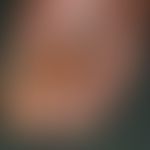 Fußinfekt, gramnegativer. Im Bereich des Vorfußes und der Digites I u. II zeigt sich eine bis an ...
