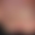 Fußinfekt, gramnegativer. Detailaufnahme: Deutlich sichtbar sind die  flächigen Substanzdefekte u...