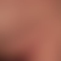 Galli-Galli, M.&nbsp;Dissemnierte, fleckförmige, z.T. auch konfluierendte rot-braune Fecken, Pape...